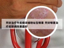 开封治疗牛皮癣详细地址在哪里 开封哪里治疗皮肤病效果最好