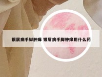 银屑病手脚肿痒 银屑病手脚肿痒用什么药
