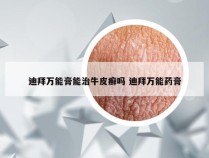 迪拜万能膏能治牛皮癣吗 迪拜万能药膏