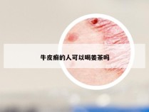 牛皮癣的人可以喝姜茶吗