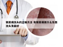 银屑病洗头的正确方法 有银屑病用什么东西洗头发最好