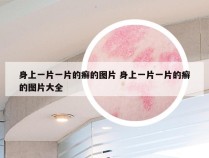 身上一片一片的癣的图片 身上一片一片的癣的图片大全