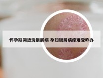 怀孕期间烫洗银屑病 孕妇银屑病痒难受咋办