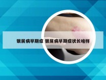 银屑病早期症 银屑病早期症状长啥样