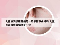 儿童点滴状银屑病是一辈子都不会好吗 儿童点滴状银屑病终身不犯