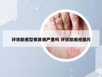 环状脓疱型银屑病严重吗 环状脓疱疮图片