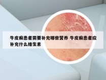 牛皮癣患者需要补充哪些营养 牛皮癣患者应补充什么维生素