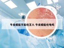 牛皮癣能不能吃王八 牛皮癣能吃龟吗