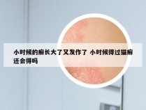 小时候的癣长大了又发作了 小时候得过猫癣还会得吗