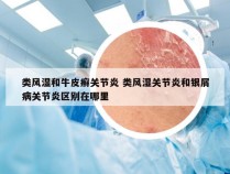 类风湿和牛皮癣关节炎 类风湿关节炎和银屑病关节炎区别在哪里