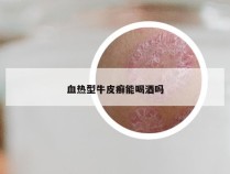 血热型牛皮癣能喝酒吗
