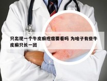 只出现一个牛皮癣疙瘩要看吗 为啥子有些牛皮癣只长一团