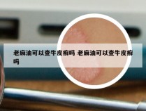 老麻油可以查牛皮癣吗 老麻油可以查牛皮癣吗