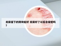 皮藓留下的斑块能好 皮藓好了以后会留疤吗?