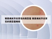 银屑病关节炎常见的类型是 银屑病关节炎常见的类型是哪些