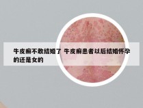 牛皮癣不敢结婚了 牛皮癣患者以后结婚怀孕的还是女的