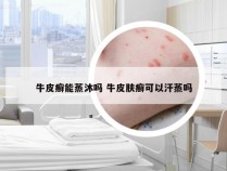 牛皮癣能蒸沐吗 牛皮肤癣可以汗蒸吗