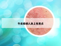 牛皮癣病人身上有黑点