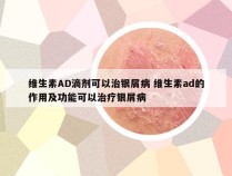 维生素AD滴剂可以治银屑病 维生素ad的作用及功能可以治疗银屑病