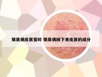 银屑病皮屑变碎 银屑病掉下来皮屑的成分