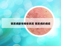 银屑病都有哪些表现 银屑病的病症