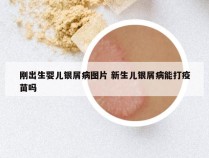 刚出生婴儿银屑病图片 新生儿银屑病能打疫苗吗