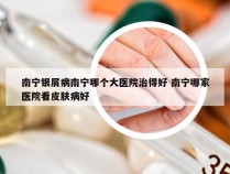 南宁银屑病南宁哪个大医院治得好 南宁哪家医院看皮肤病好