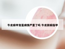 牛皮癣甲变是病情严重了吗 牛皮肤癣指甲