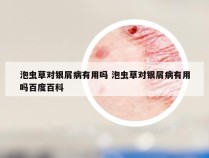 泡虫草对银屑病有用吗 泡虫草对银屑病有用吗百度百科