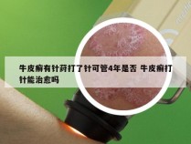 牛皮癣有针荮打了针可管4年是否 牛皮癣打针能治愈吗