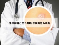 牛皮癣自己怎么判断 牛皮癣怎么诊断