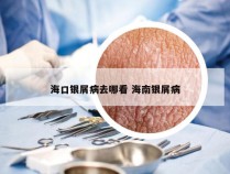 海口银屑病去哪看 海南银屑病