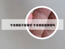 牛皮癣能不能看好 牛皮癣能医断根吗