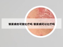 银屑病也可做化疗吗 银屑病可以化疗吗