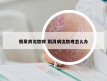 银屑病流脓疼 银屑病流脓疼怎么办