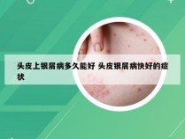 头皮上银屑病多久能好 头皮银屑病快好的症状