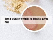 氯霉素可以治疗牛皮癣吗 氯霉素可以治疗脚气吗