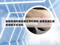 副银屑病和银屑病会同时得吗 副银屑病比银屑病更不好治吗