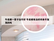 牛皮癣一辈子治不好 牛皮癣有治好终身不复发的吗