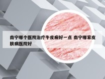 南宁哪个医院治疗牛皮癣好一点 南宁哪家皮肤病医院好