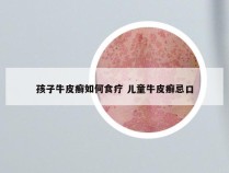 孩子牛皮癣如何食疗 儿童牛皮癣忌口