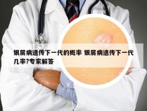 银屑病遗传下一代的概率 银屑病遗传下一代几率?专家解答