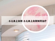 小儿身上白斑 小儿身上白斑如何治疗