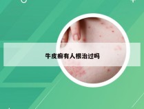 牛皮癣有人根治过吗