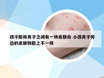 孩子脸和鼻子之间有一块皮肤白 小孩鼻子旁边的皮肤和脸上不一样