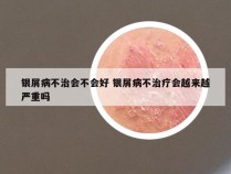 银屑病不治会不会好 银屑病不治疗会越来越严重吗