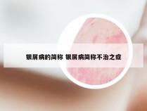 银屑病的简称 银屑病简称不治之症