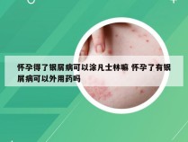 怀孕得了银屑病可以涂凡士林嘛 怀孕了有银屑病可以外用药吗