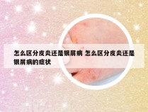 怎么区分皮炎还是银屑病 怎么区分皮炎还是银屑病的症状