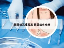 银屑病又痒又丑 银屑病有点痒